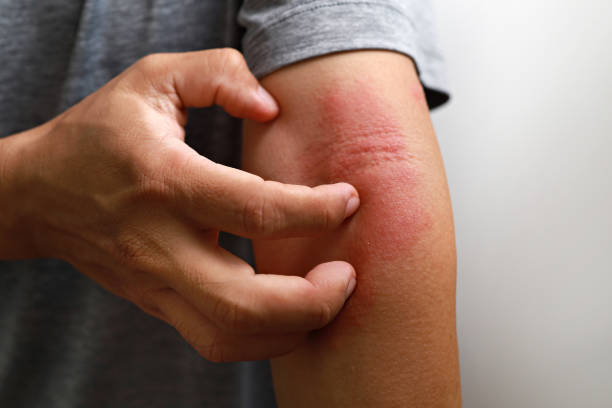 Close up of man having itch caused of a red rash stock photo