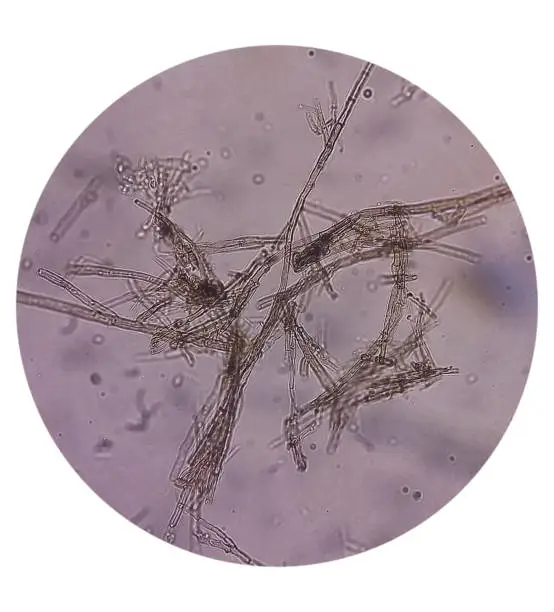 Photo of Microscopic fungi Malassezia furfur, showing yeast cells and hyphae. They are associated with dandruff, seborrhoeic dermatitis and tinea versicolor. Skin scraping for fungus.