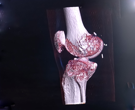 Fracture bone, knee joint, ct scan image, medical concept.