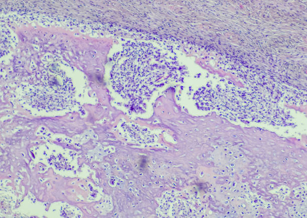 Conventional Osteosarcoma el osteosarcoma convencional de alto grado es típicamente de alto grado y se origina en la cavidad intramedular. en las radiografías, la sg puede ser osteolítica u osteoblástica, o ambas. el ochenta por ciento de los casos se localizan en la metáfisis