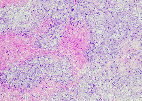 Metaplastic breast carcinoma with mesenchymal differentiation