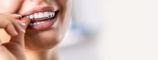 eine frau setzt einen unsichtbaren silikon-zahn-aligner auf. zahnspangen zur zahnkorrektur. - zahnschiene stock-fotos und bilder