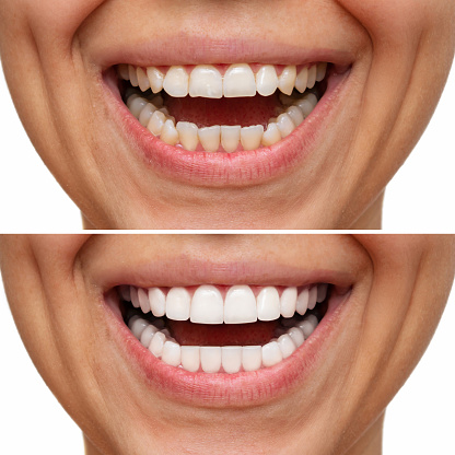 Cropped shot of a young caucasian smiling woman before and after veneers installation. Teeth whitening. Dentistry, dental treatment