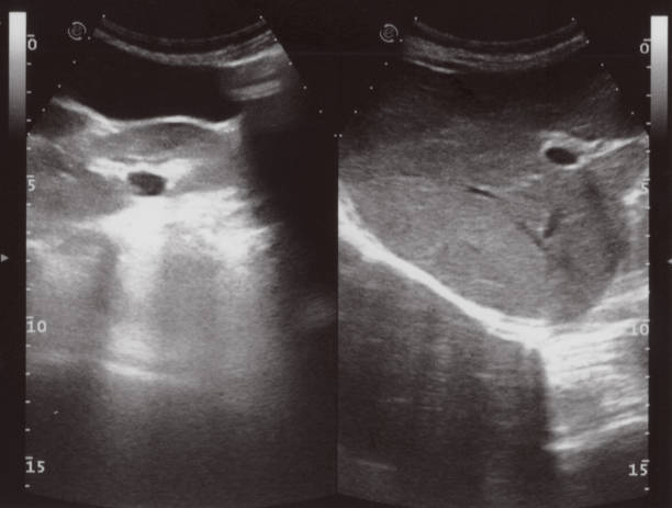 istock full abdomen ultrasound sonogram 1433874653