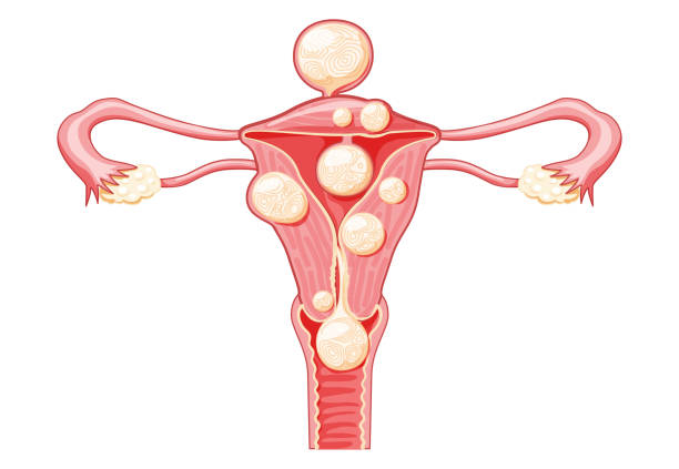 子宮筋腫 女性の平滑筋腫生殖器系子宮。正面図。人体解剖学医療イラストは、孤立した内臓位置スキーム、子宮頸部、卵巣、卵管フラットスタイルアイコン - vaginal canal illustrations点のイラスト素材／クリップアート素材／マンガ素材／アイコン素材