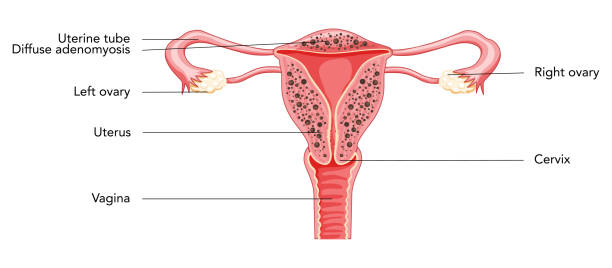 istock Diffuse Adenomyosis with inscriptions, Human anatomy Female reproductive Sick system organs. Structure of uterus, cervix, ovary, fallopian tube in Latin text. Frontal view in a cut Vector illustration 1433926067