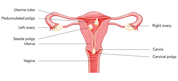 istock Polyp in the uterus with inscriptions diagram Female reproductive system in cross sections. Front view in a cut. Human anatomy diseases internal organs location scheme, cervix, ovary flat style icon 1433926560