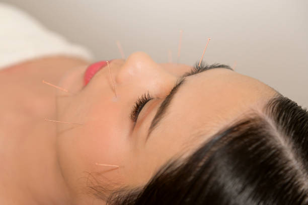 bella donna ha ricevuto un trattamento di agopuntura sul viso dal terapeuta, trattamento di medicina cinese, concetto di salute e guarigione. - acupuncture spa treatment asian culture medicine foto e immagini stock