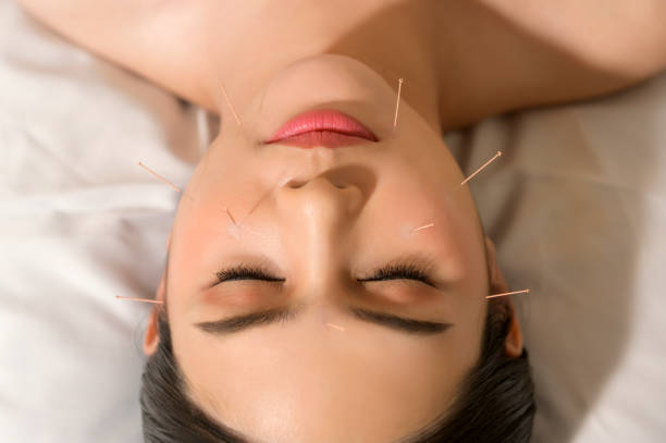 bella donna ha ricevuto un trattamento di agopuntura sul viso dal terapeuta, trattamento di medicina cinese, concetto di salute e guarigione. - alternative therapy massaging clinic health spa foto e immagini stock