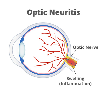 Vector scientific medical illustration of optic neuritis isolated on a white background. Nerve fibers are inflamed, and the optic nerve is swollen. Temporary vision loss and visual field loss. Eye inflammation.