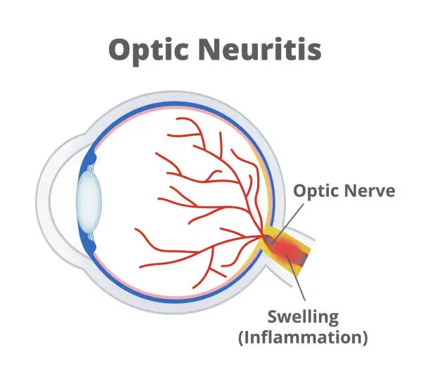 Vector illustration of Optic Neuritis. Nerve fibers are inflamed, and the optic nerve is swollen. Temporary vision loss and visual field loss. Eye inflammation.