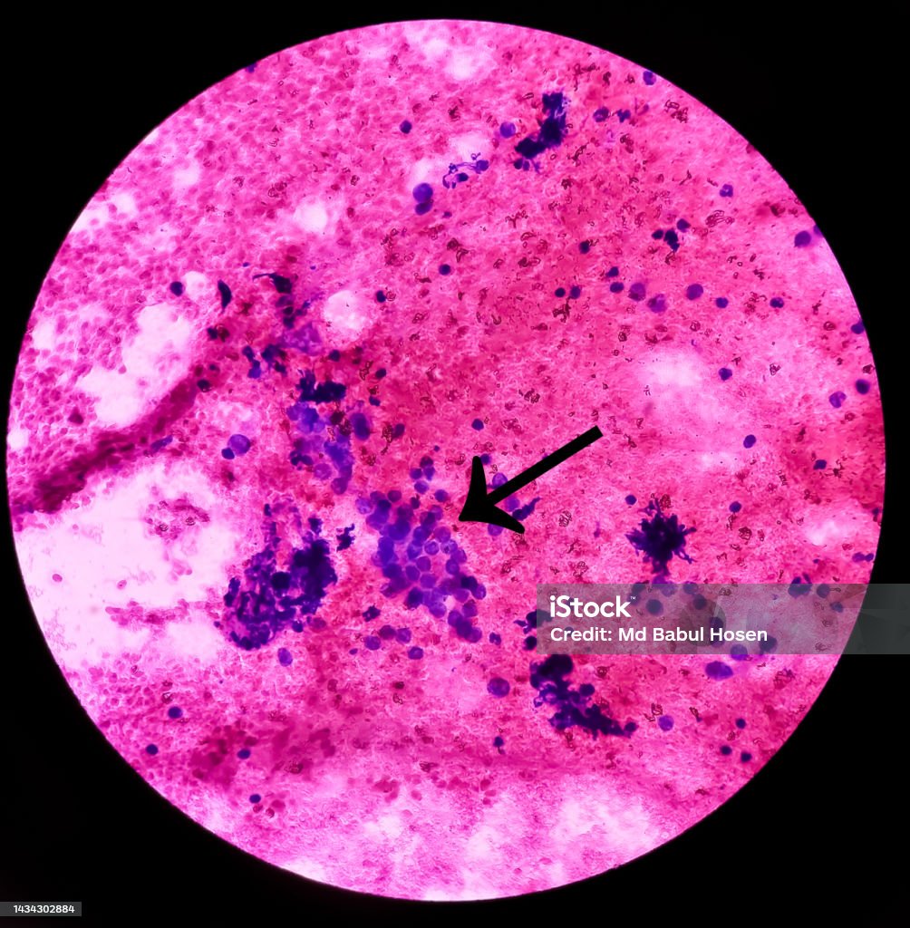 Sưng Tuyến Giáp Tổn Thương Nang Tế Bào Hình Ảnh Hiển Vi Cho Thấy ...