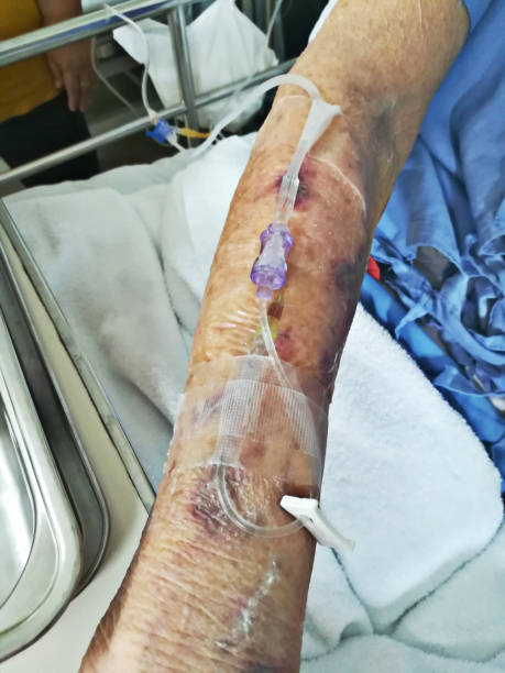 eine ältere frau erhielt antibiotika durch eine spritze intravenös in ihrem arm. - iv bruise stock-fotos und bilder