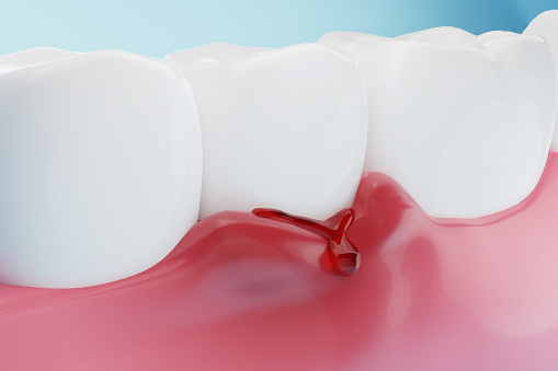 Bleeding gums. dental hygiene and healthy teeth concept. 3D rendering.