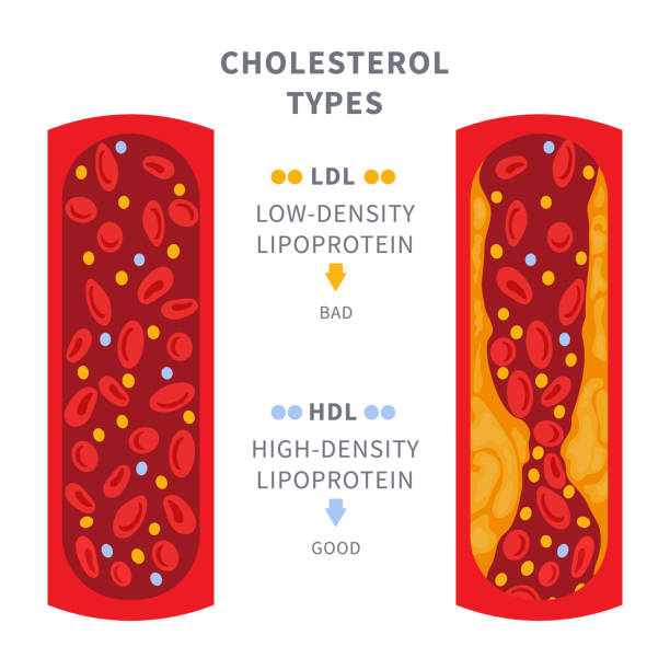 Normal and blocked artery with cholesterol clot infographics Healthy and narrowed blood vessel with cholesterol plaque buildup. Artery blocked with a fat cells clot. ldl and hdl lipoprotein comparison. Cross section medical diagram. Vector illustration. cholesterol screening stock illustrations