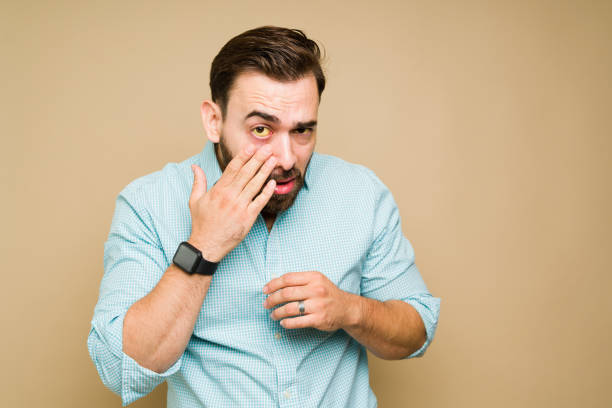 hombre enfermo con ojos amarillos enfermo de cirrosis - ojos amarillos fotografías e imágenes de stock