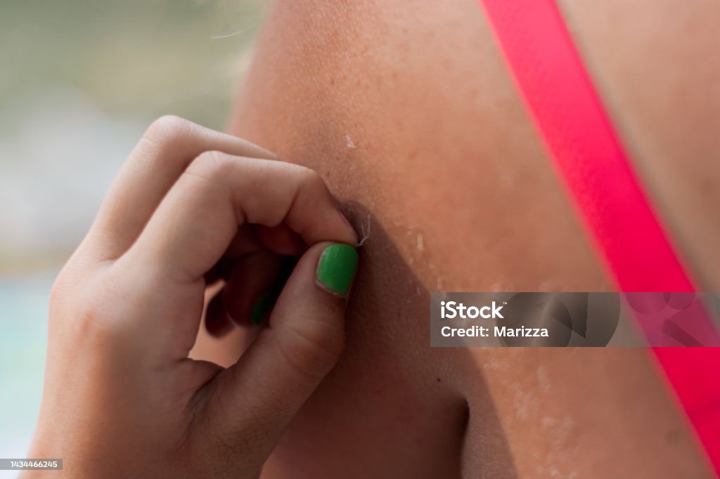 Sunburn on the skin of the back. Exfoliation, skin peels off. Dangerous sun tan Dry Stock Photo