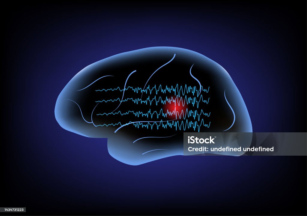 Oct19seizure Stock Illustration - Download Image Now - Brain Wave ...