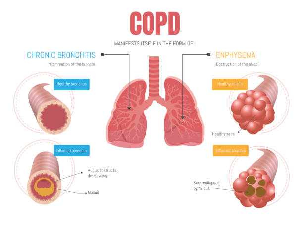 Epoc infographic: manifests itself in two forms emphysema and bronchitis Epoc infographic: manifests itself in two forms emphysema and bronchitis bronchitis stock illustrations