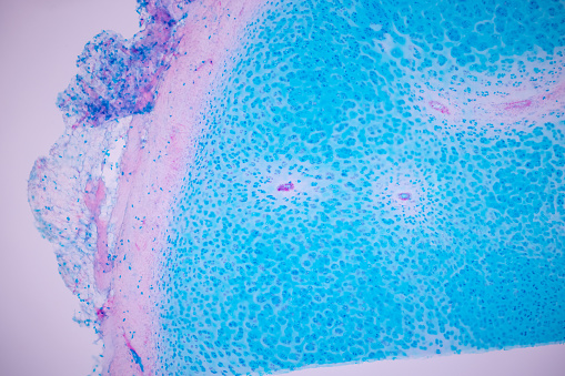 Serous papillary carcinoma of the endometrium. Ki67 immuno stain.