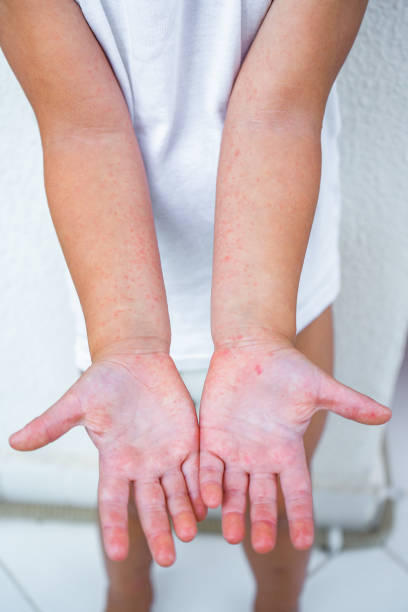 Enterovirus Leg - arm - mouth. Rash on the body of a child. Cocksackie virus. Enterovirus Leg - arm - mouth. Rash on the body of a child. Cocksackie virus. High quality photo hand foot and mouth disease stock pictures, royalty-free photos & images