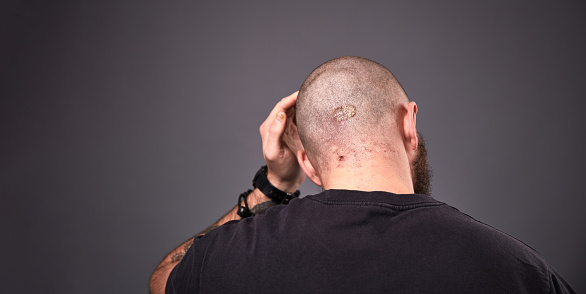 Man with dry flaky skin on his head with psoriasis and nail fungus on hands. Autoimmune genetic disease.