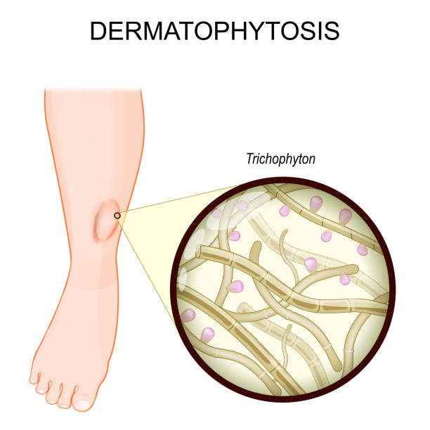 Dermatophytosis. Ringworm on a human leg. Dermatophytosis. Ringworm on a human leg. fungal infection of the skin. Close-up of a Trichophyton. fungi that caused Ringworm disease. vector illustration trichophyton fungus stock illustrations