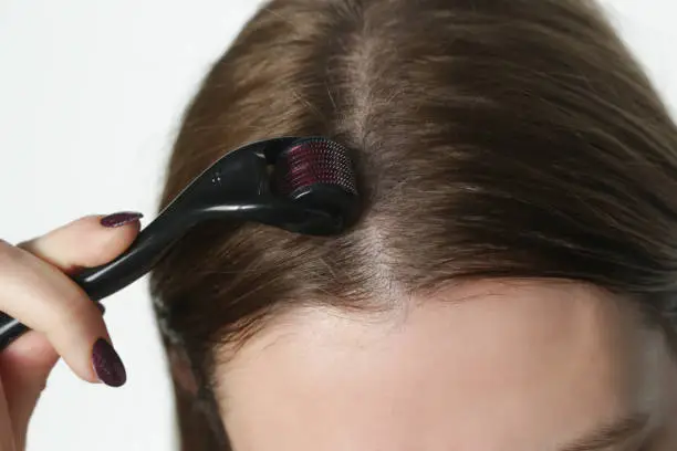 Photo of Woman using microneedle derma roller on head for stimulating new hair growth. Simple and cheap treatment for the healthy scalp.