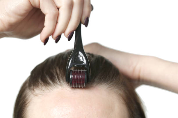 istock Woman using microneedle derma roller on head for stimulating new hair growth. Simple and cheap treatment for the healthy scalp. 1435675642