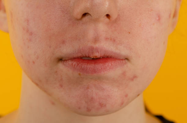istock Teen girl with acne problem 1435763429