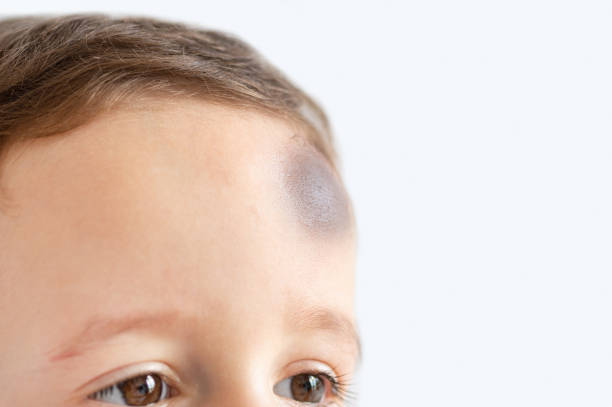 little boy with injury on head - careless child rudeness little boys imagens e fotografias de stock