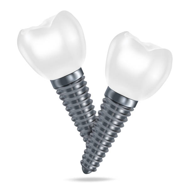 wektorowe 3d realistyczne renderowanie białych protez implantów dentystycznych z bliska izolowanych na białym tle. koncepcja stomatologii, medycyny i opieki zdrowotnej. szablon projektu protezy. pierwszym planie. - implant stock illustrations