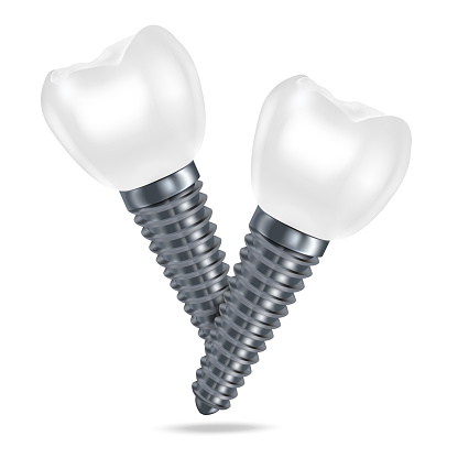 Vector 3d realistic rendering of white dental implant dentures closeup isolated on white background. Dentistry, medicine and healthcare concept. Prosthesis design template. Foreground