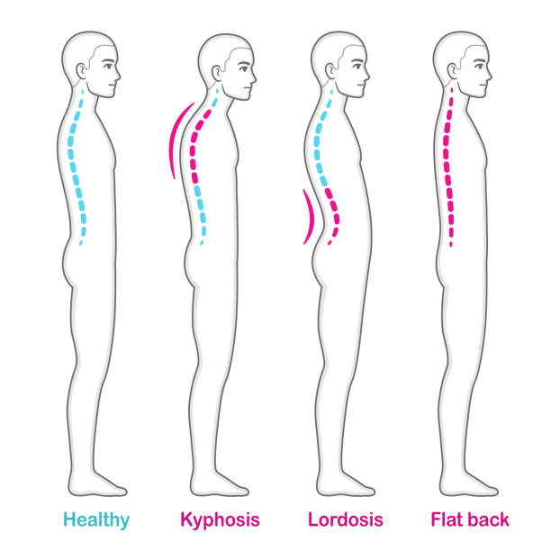 Posture and back problems spine infographic Back posture problems medical diagram. Young man with kyphosis, lordosis and flat back, healthy spine comparison. Infographic vector illustration. kyphosis stock illustrations