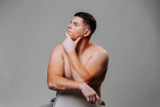 istock Young man vitiligo in studio shot gray background poses with please one hand on face other on face. 1436042132