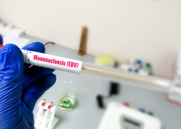 Scientist hold saliva sample for Infectious mononucleosis (mono) test, is often called the kissing disease caused by Epstein-Barr virus. Scientist hold saliva sample for Infectious mononucleosis (mono) test, is often called the kissing disease caused by Epstein-Barr virus. epstein barr virus photos stock pictures, royalty-free photos & images