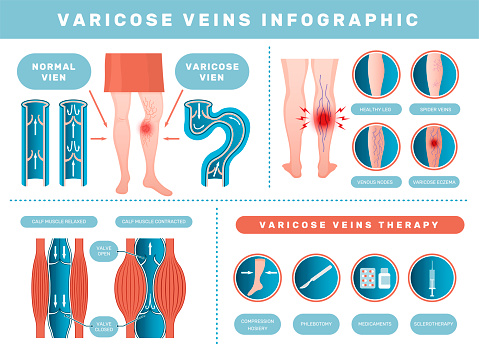 Varicose infographic. Venous disease medical health problems with human blood venous recent vector template set of health body thrombosis and treatment illustration