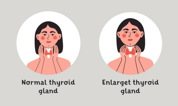 Normal and enlarget thyroid gland. Woman showing thyroid gland on her neck. Endocrinology system symbol, organ responsible for hormone production. Flat vector isolated illustration Normal and enlarget thyroid gland. Woman showing thyroid gland on her neck. Endocrinology system symbol, organ responsible for hormone production. Flat vector isolated illustration. Graves Disease stock illustrations