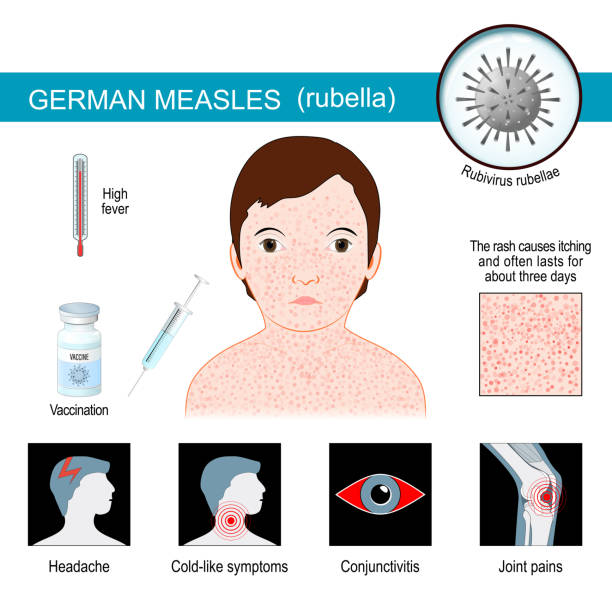 German measles. infographics about symptoms of Rubella German measles. infographics about Signs and symptoms of Rubella. three-day measles is disease that caused by infection of the rubella virus. Vector illustration. measles illustrations stock illustrations