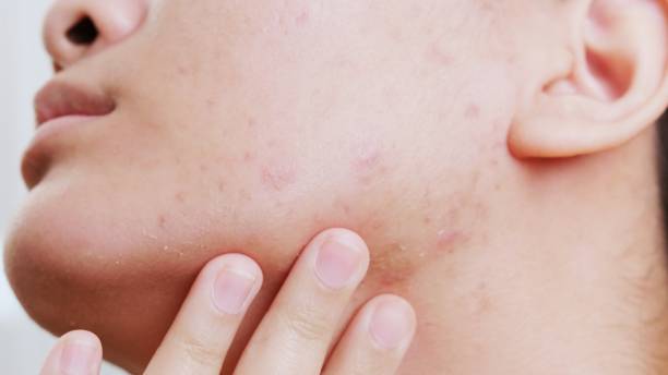 istock Young women with problematic skin and pimples on her face. 1436684938