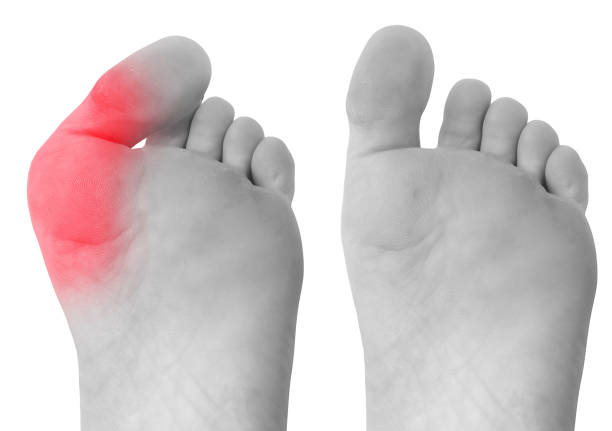 istock Bunion before and after surgical removal 1436711770