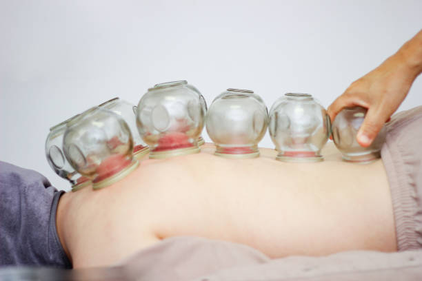 istock Acupuncture Fire cupping detail on woman's back 1436714916