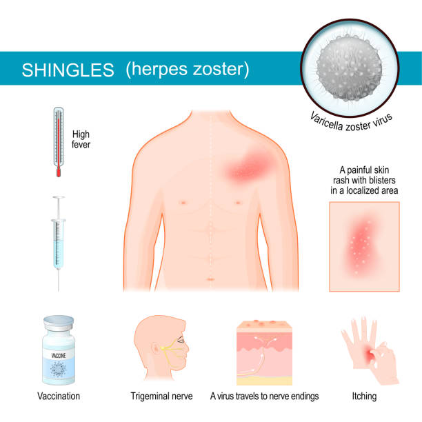 dachschindeln. infografiken über symptome von herpes zoster. - zoster stock-grafiken, -clipart, -cartoons und -symbole