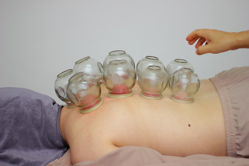 Fire Cupping characteristic natural remedies in Chinese medicine, female's back