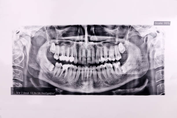 istock Panoramic dental tooth X-ray examination of the jaw 1436763765