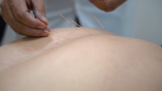 Acupuncture. Close-up of man's back with needles stuck in. Chinese medicine with acupuncture. Man recovers health at professional masseur on Chinese medicine.