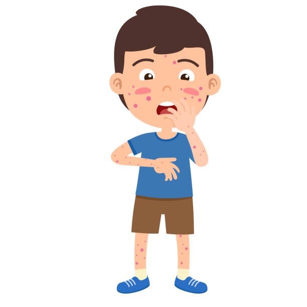 kid boy suffering from measles vector illustration kid boy suffering from measles vector illustration measles illustrations stock illustrations