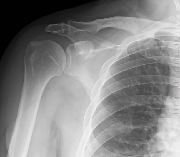 istock X-ray shoulder joints. Acromioclavicular bones. Medical concept. X-ray shoulder joints structure. 1436915924