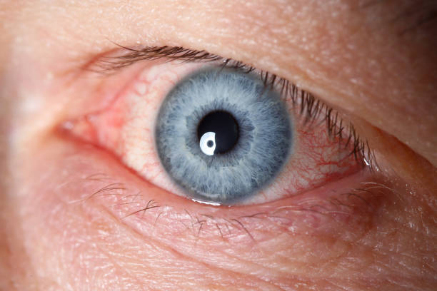 istock Irritated left blue male eye full with red capillar net 1436924257