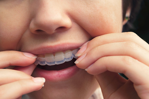 Teenage girl positioning transparent dental aligners on her teeth.